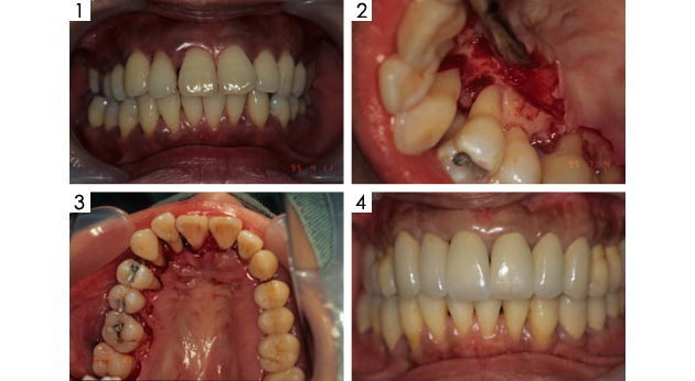 歯周病の外科手術